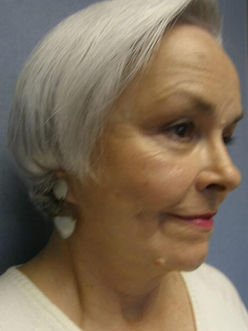 Facelift Before & After Image