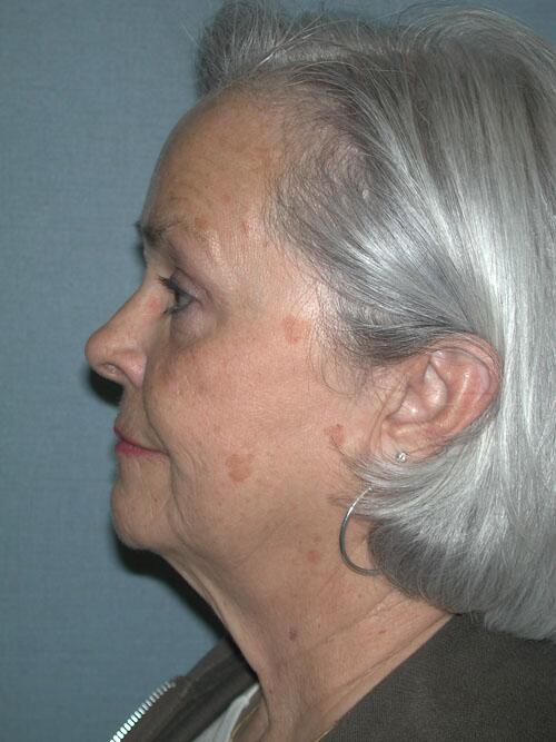 Facelift Before & After Image