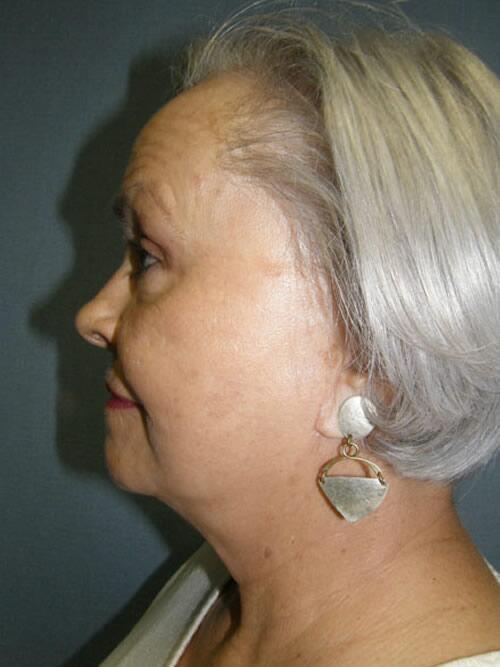 Facelift Before & After Image