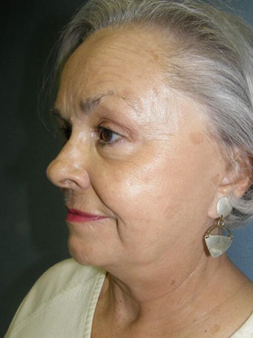 Facelift Before & After Image