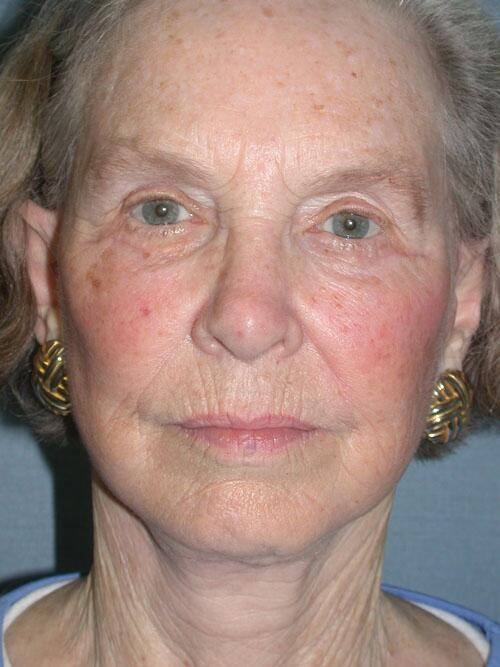 Facelift Before & After Image