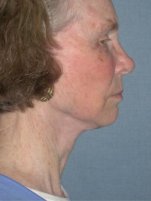 Facelift Before & After Image