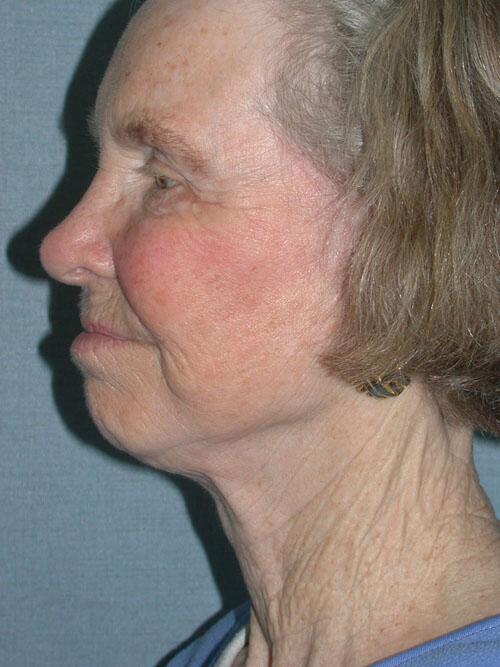 Facelift Before & After Image