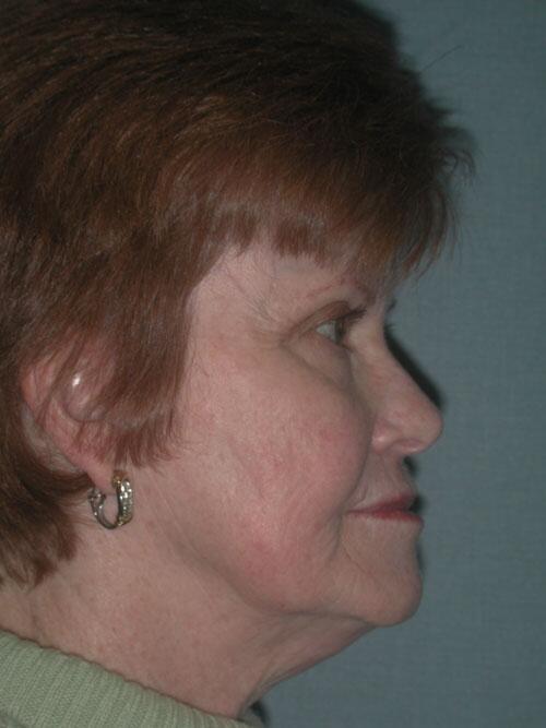 Facelift Before & After Image