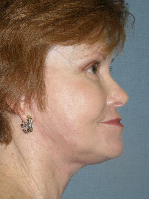 Facelift Before & After Image