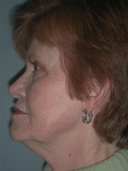 Facelift Before & After Image