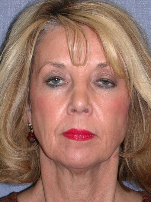 Facelift Before & After Image