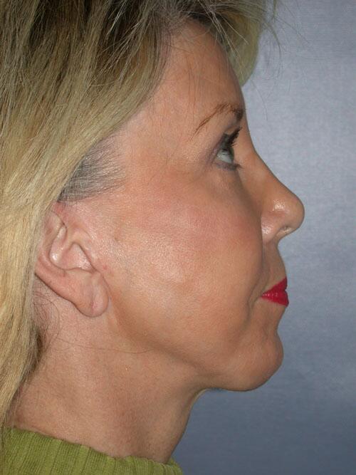 Facelift Before & After Image