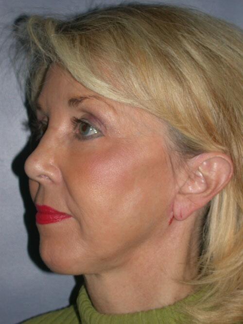 Facelift Before & After Image