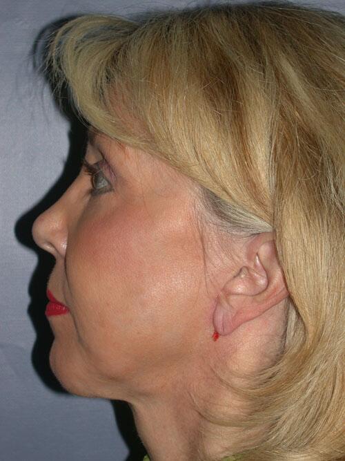 Facelift Before & After Image