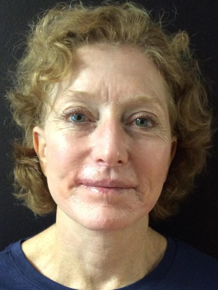 Facelift Before & After Image