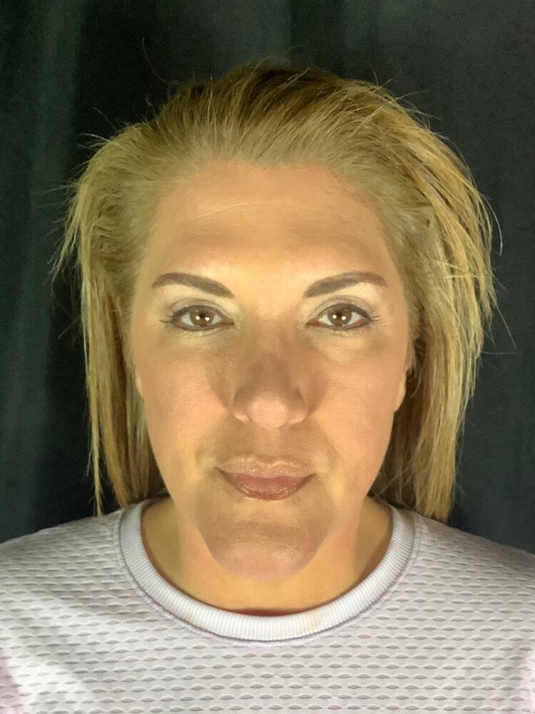 Facelift Before & After Image