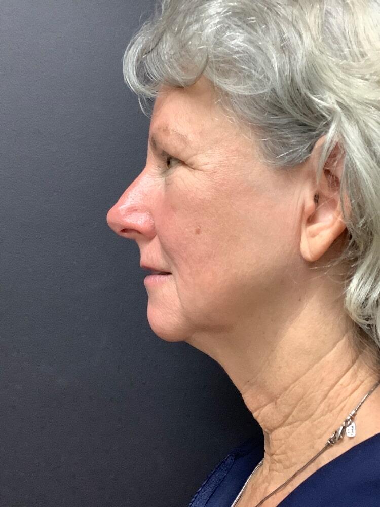 Facelift Before & After Image