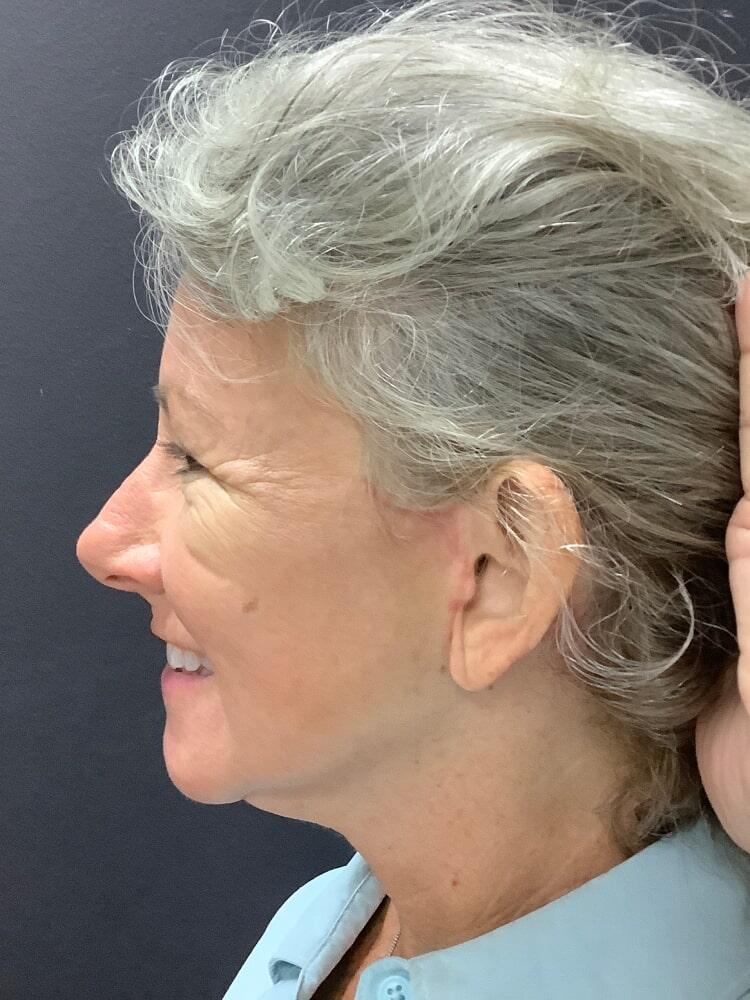 Facelift Before & After Image