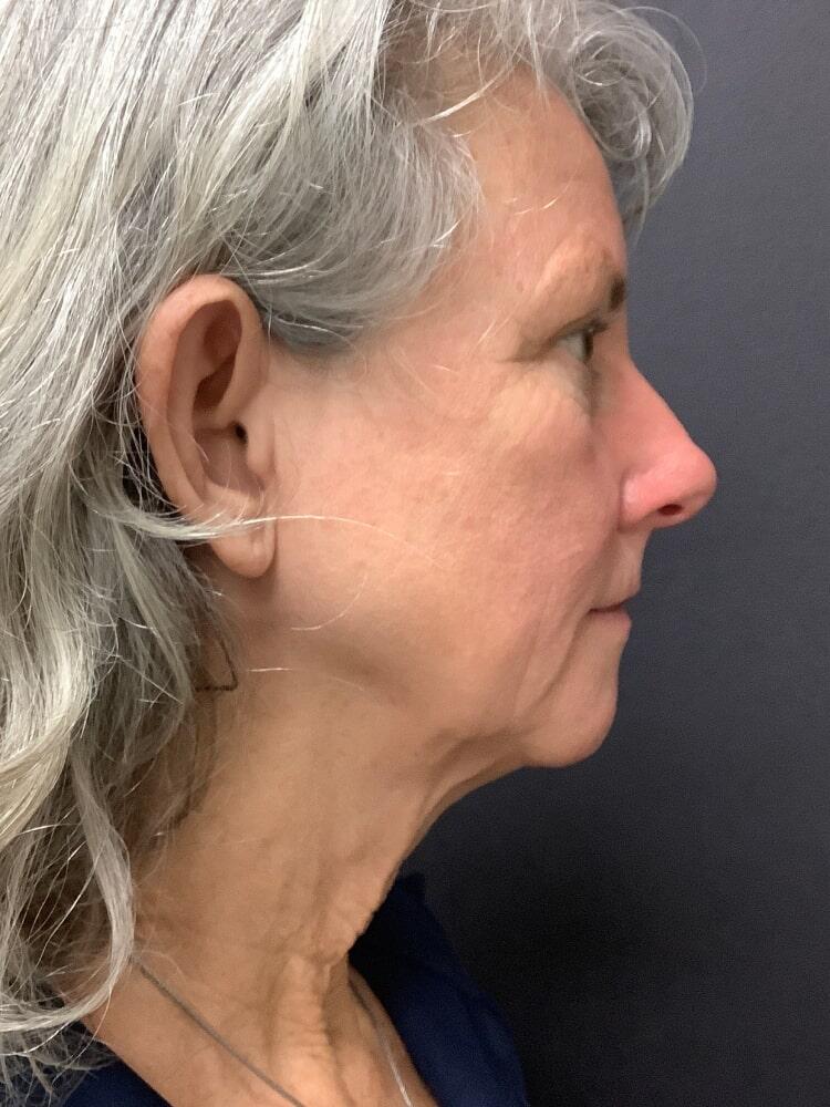 Facelift Before & After Image