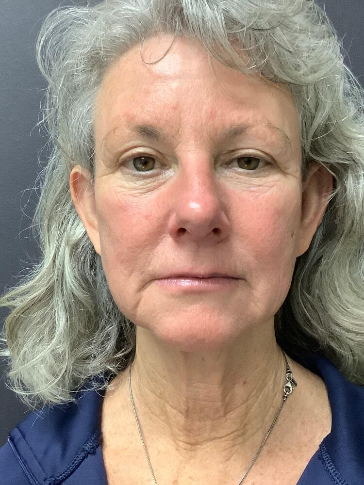 Facelift Before & After Image