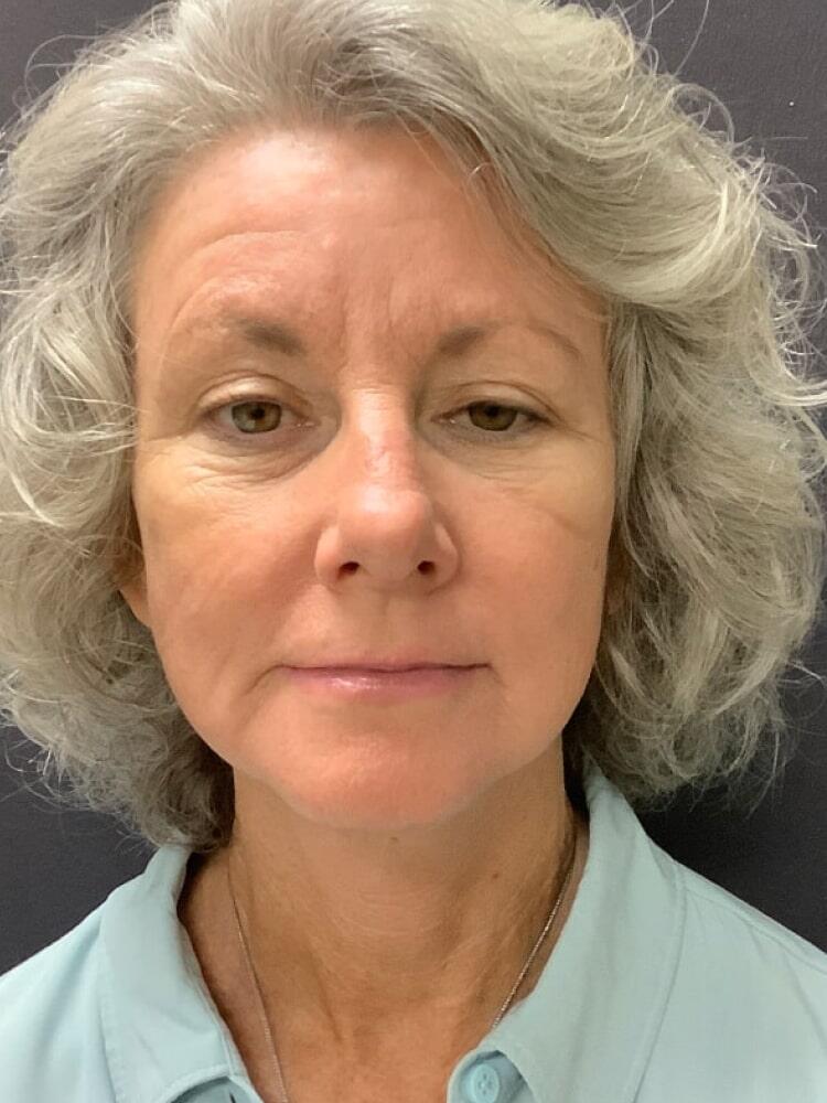 Facelift Before & After Image