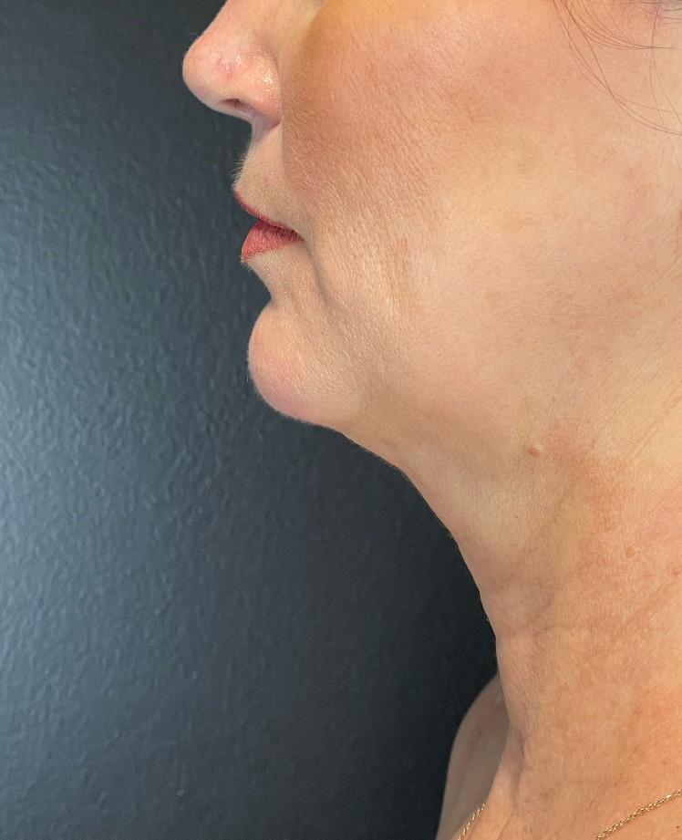 Facetite Before & After Image