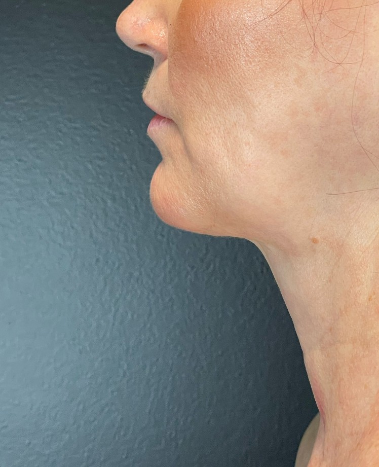 Facetite Before & After Image