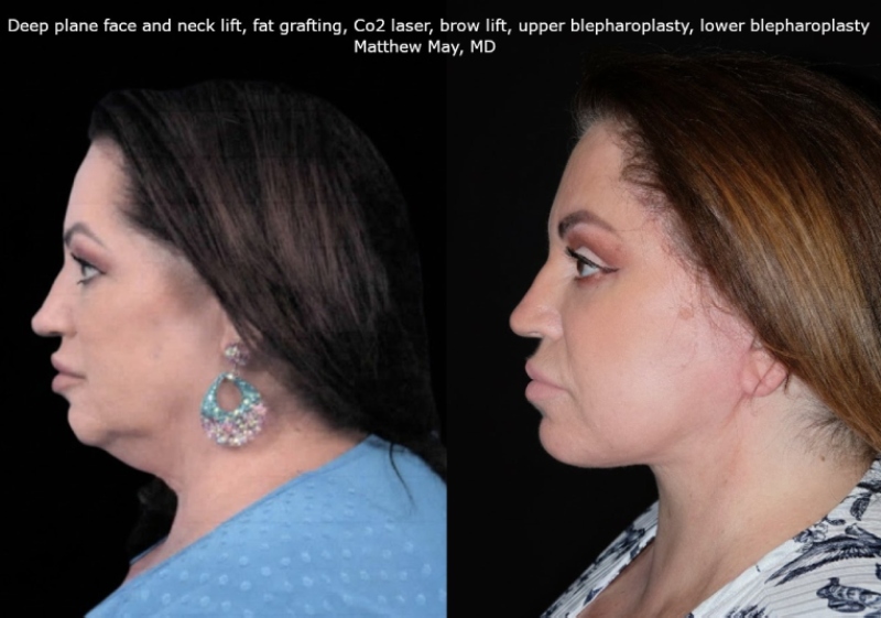 Fat Grafting Before & After Image