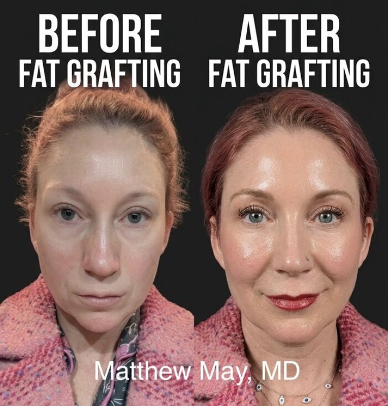 Fat Grafting Before & After Image