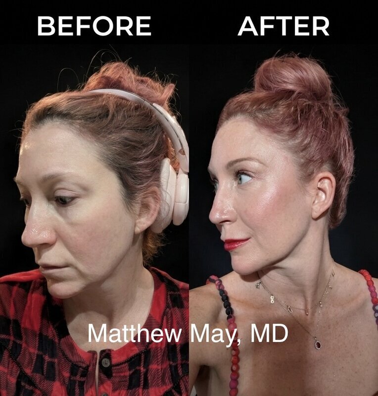 Fat Grafting Before & After Image
