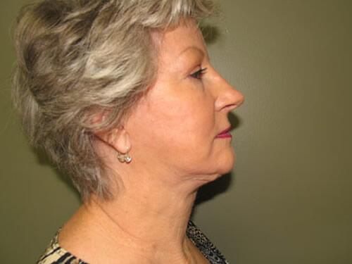 Neck Lift Before & After Image