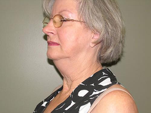 Neck Lift Before & After Image