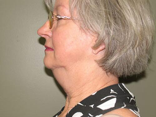 Neck Lift Before & After Image