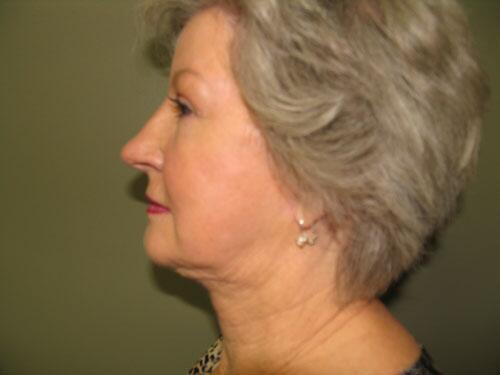 Neck Lift Before & After Image