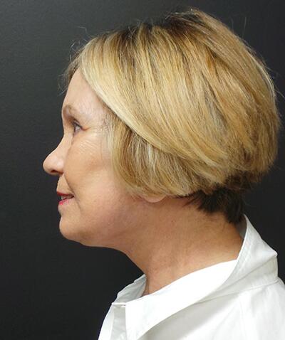 Neck Lift Before & After Image