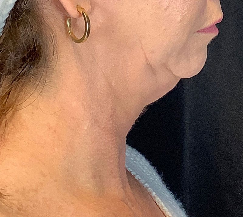 Neck Lift Before & After Image