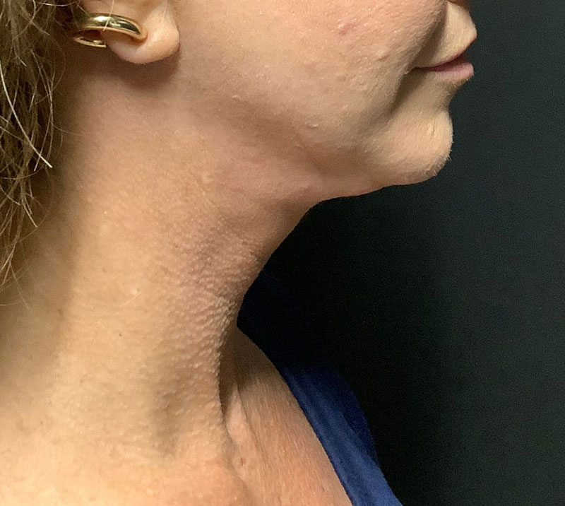 Neck Lift Before & After Image