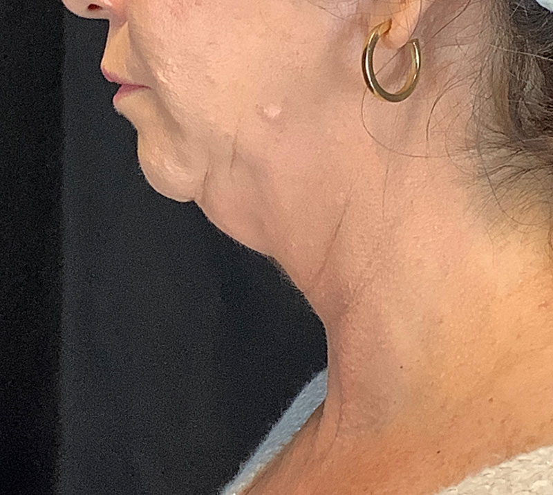 Neck Lift Before & After Image