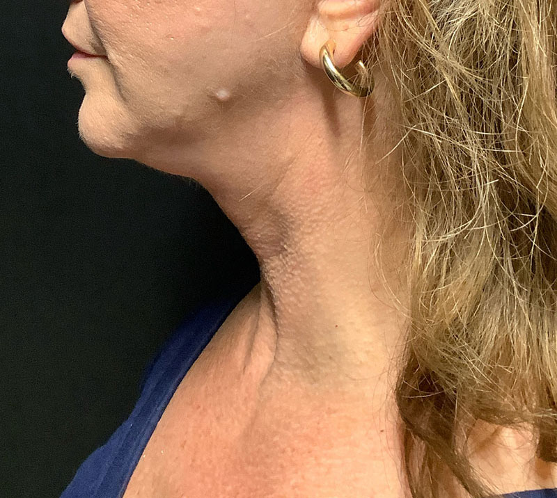Neck Lift Before & After Image