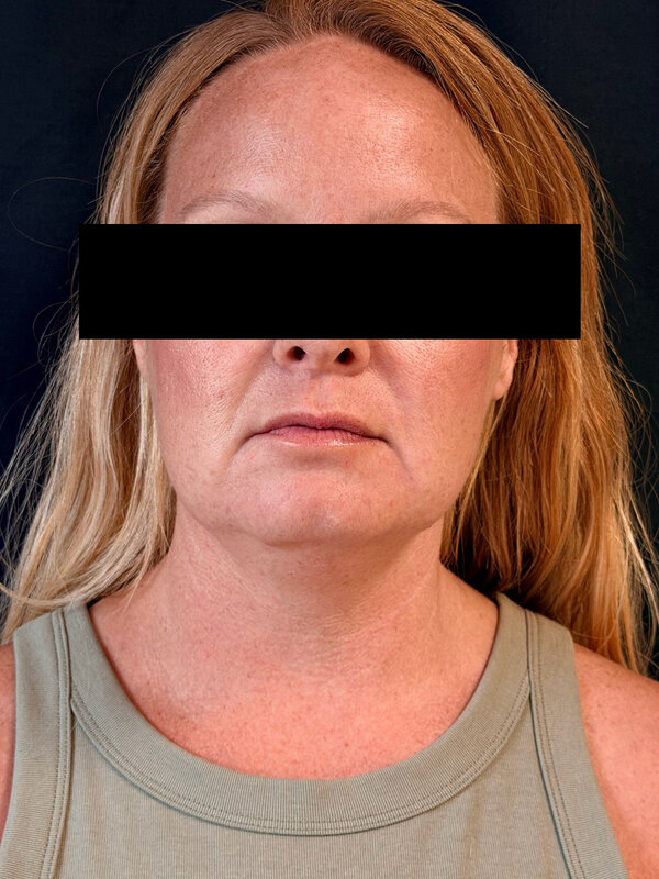 NeckTite Before & After Image