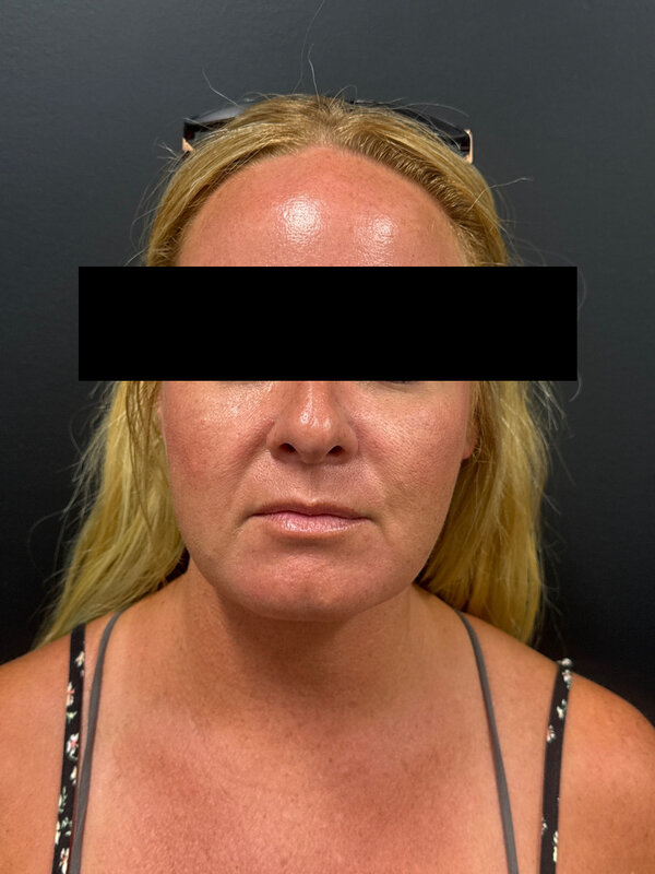 NeckTite Before & After Image