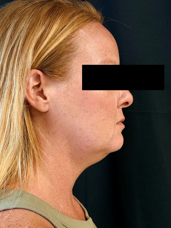 NeckTite Before & After Image
