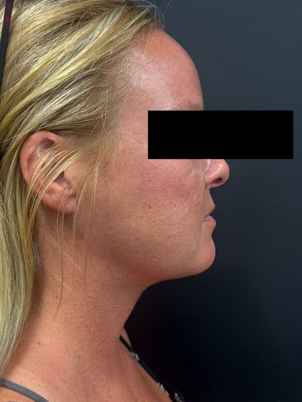 NeckTite Before & After Image