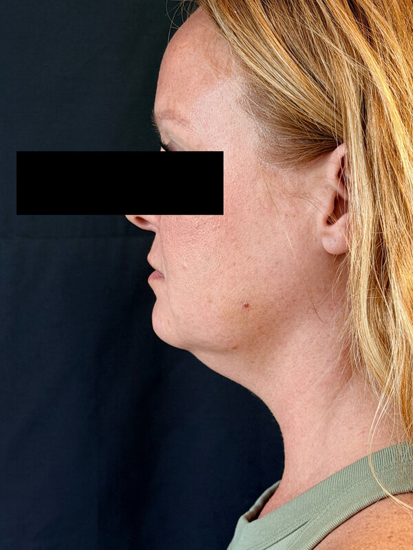 NeckTite Before & After Image