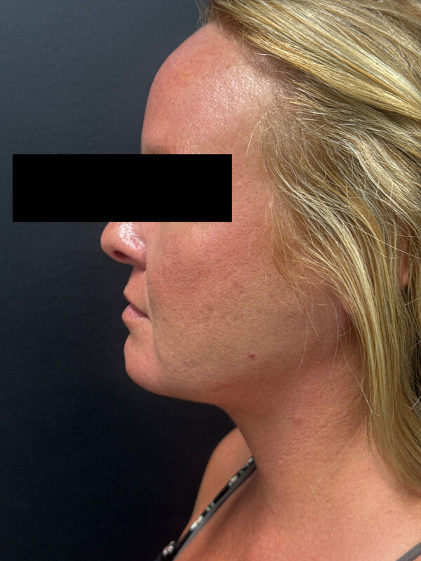 NeckTite Before & After Image