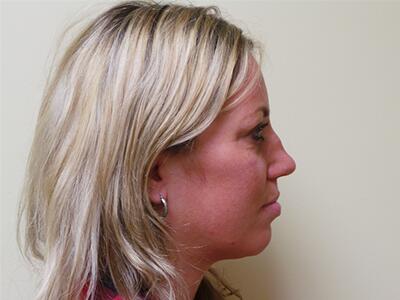 Rhinoplasty Before & After Image