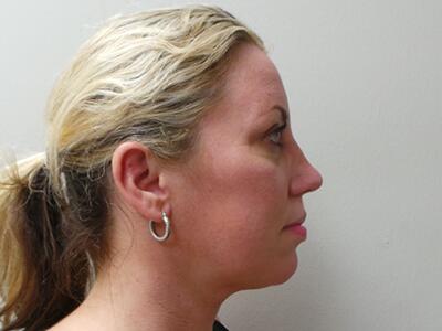 Rhinoplasty Before & After Image