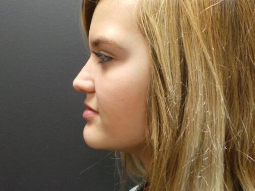 Rhinoplasty Before & After Image