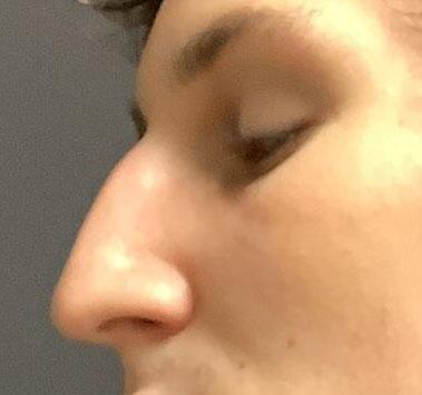 Rhinoplasty Before & After Image