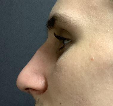 Rhinoplasty Before & After Image