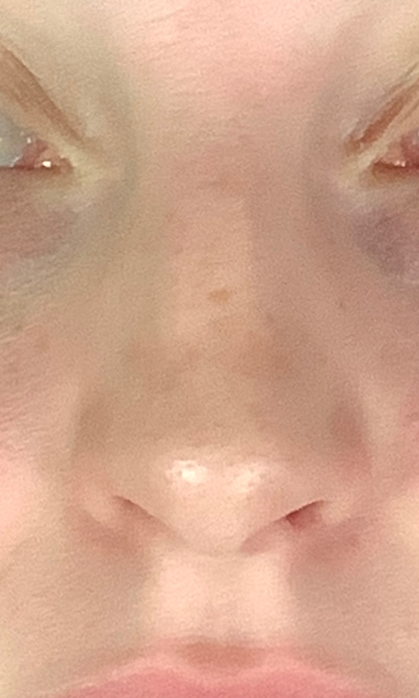 Rhinoplasty Before & After Image