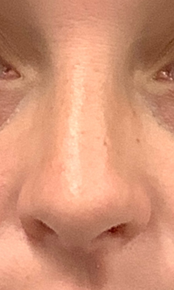 Rhinoplasty Before & After Image