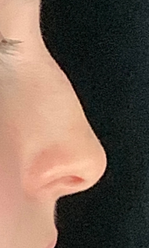 Rhinoplasty Before & After Image