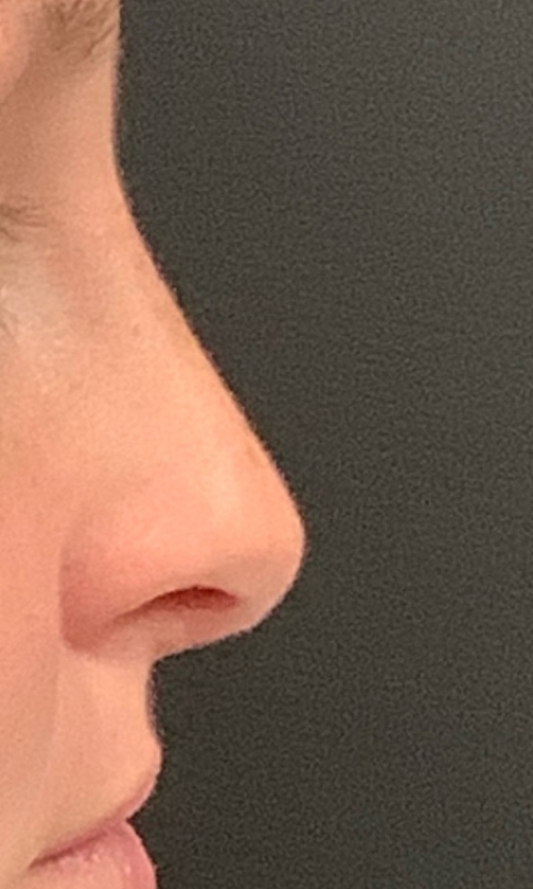 Rhinoplasty Before & After Image